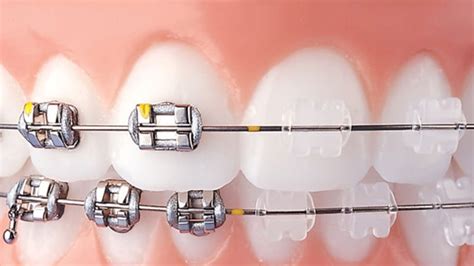 brackets de porcelana vs metal|Brackets Cerámicos Vs Metálicos: 7 Diferencias .